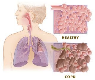 Copd versus healthy lung