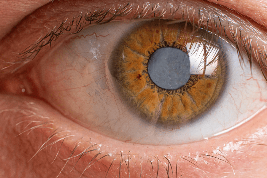 Fundus photographs of cataract