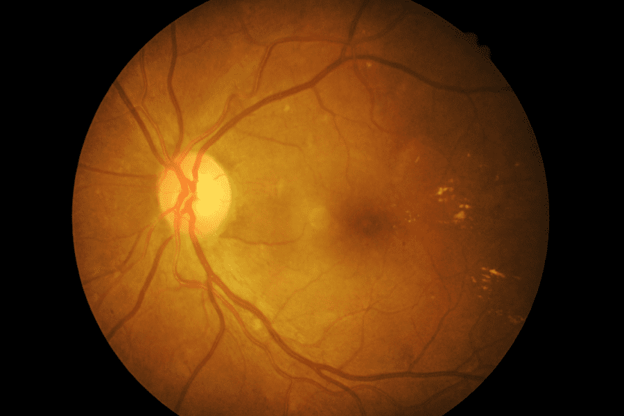 Fundus photograph diabetic retinopathy visual impairment