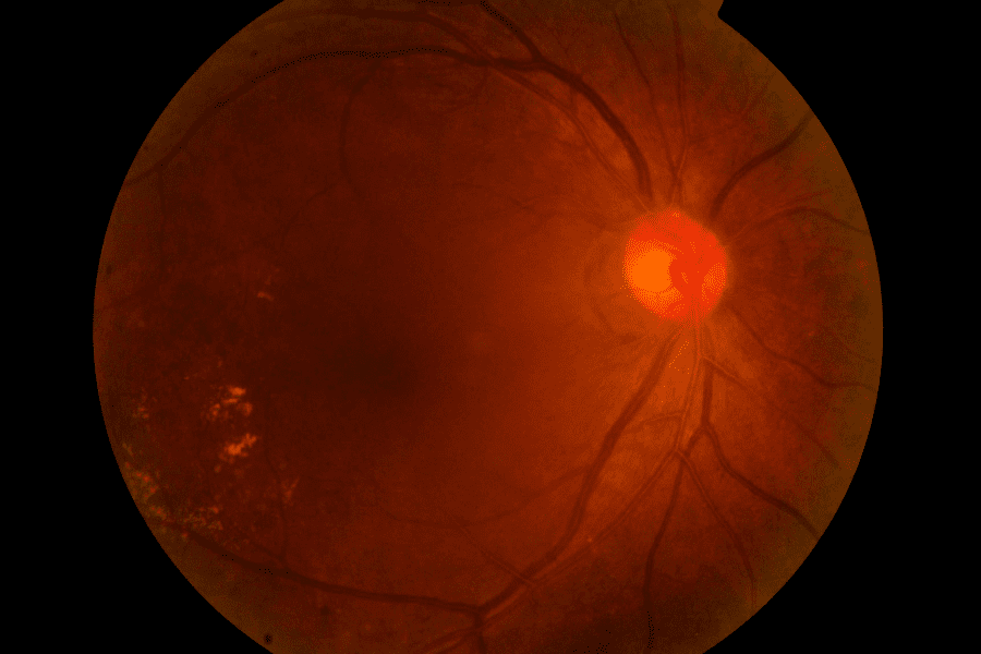 Fundus photographs of glaucoma visual impairment